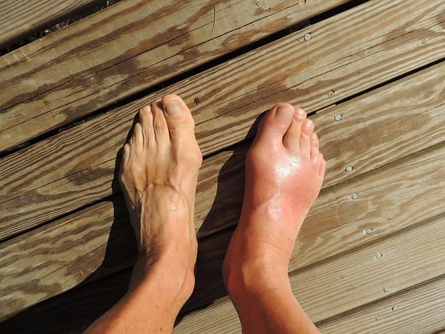 feet, gout, pain, foot, human, anomaly, barefoot, flatfoot, toes, ankle, sole, brown pain, brown human, gout, gout, gout, gout, gout, pain, foot